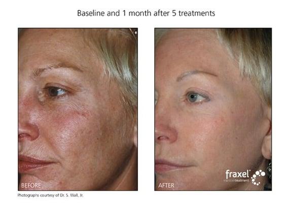 Before and After of Fraxel Treatments at Fountain of Youth Medical Spa