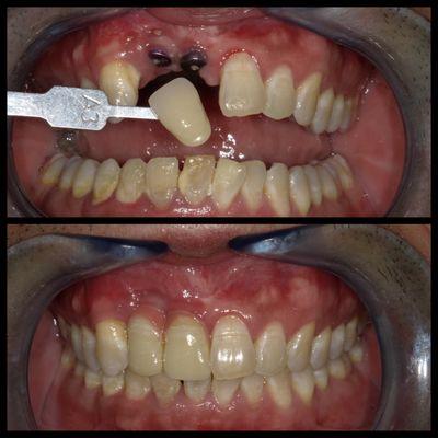 Implant crowns