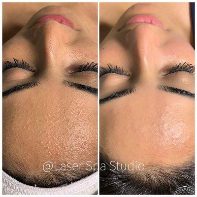 Before and afters from only one  deep pore cleansing facial treatment!