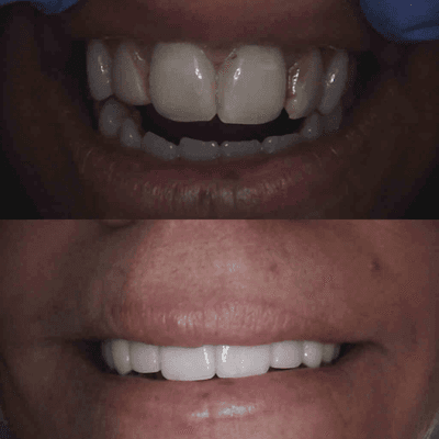 Veneers before and after