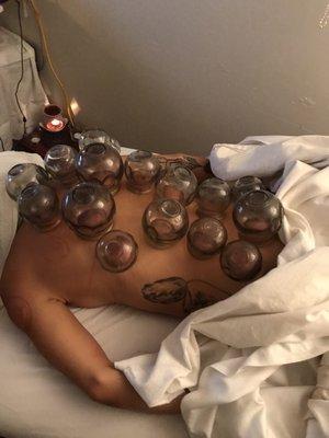 5/14/2021 cupping Treatment on overworked young woman body to reduce the stress and anxiety