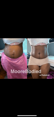 Lipo non Surgical