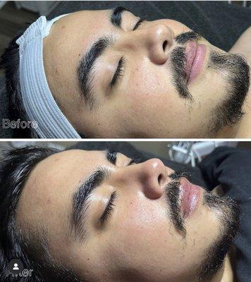 Men's Facial before and after