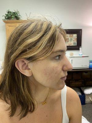 After Picture of Acne Treatment that included, chemical peel, microdermabrasion, dermaplaning