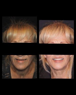 Smile Makeover