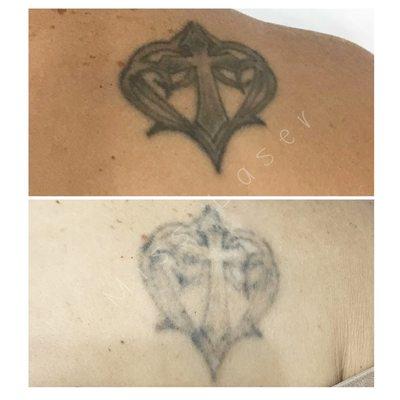 Tattoo removal