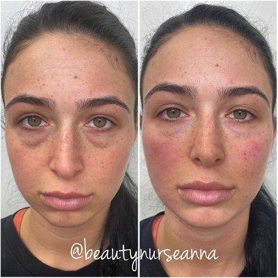 Before and After my signature under eye filler treatment