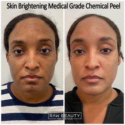 Medical Grade Chemical Peel