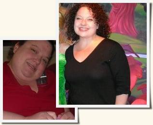 Rhonda - Roux-en-Y Gastric Bypass before and after