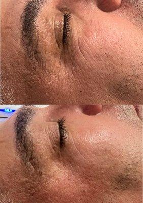 Before and after 1 session of cryofacial