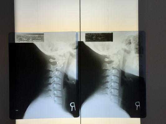 The comparison of the physiological curvature before and after the treatment.