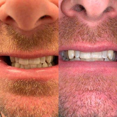 Before and After using the Glo Whitening treatment. Check out those pearly whites!