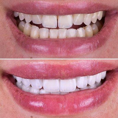 20 master ceramist beautiful veneers to change and improve this smile.