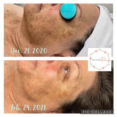 Sali-Intensify Micro-Peel results. Four of six treatments complete!