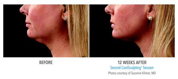 Check out these amazing Coolsculpting results!