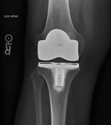 My knee replacement. Very satisfied with the result. Walking without assistance at 4 weeks!