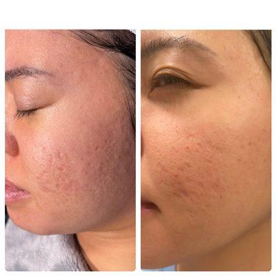 Microneedling with Chemical Peel: Before & After (2 sessions)