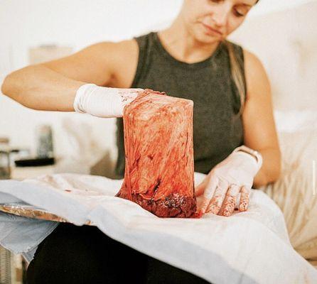 Inspecting the placenta after birth