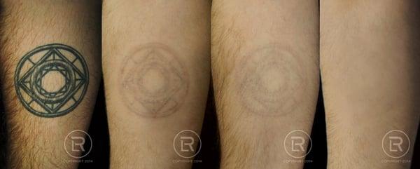 Renewal Laser Clinic Client who not only has now qualified for a career in law enforcement; but also was hired. #tattooremoval