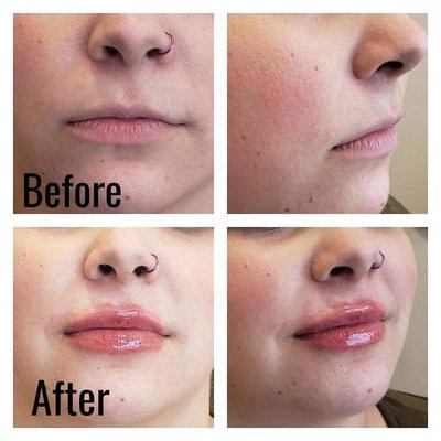 Looking for Beautiful Lips   enhanced with 1 syringe of Filler