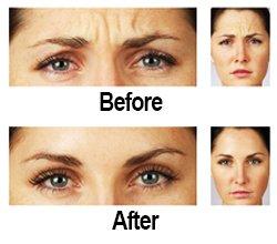 Soften lines with Botox or Dysport!