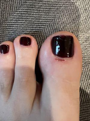 Bleeding cuticle area