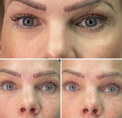 UnderEyes Dark Circles Fillers