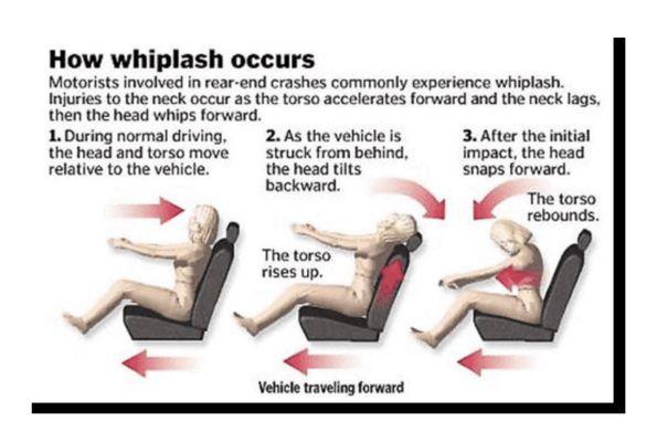 Car accident whiplash injury