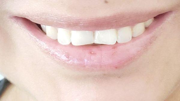 The after with 2 perfect front teeth no chipped, no gap. (Unfortunately I forgot the before pic)