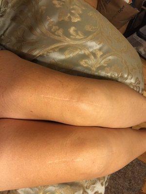 Beautiful scars after total knee replacements.