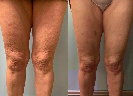 Leg Toning Cryotherapy