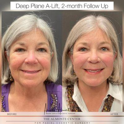 B/A: A-Lift, Dr. Almonte's signature facelift