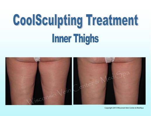 It's not about what you lose. It's what you gain. So say goodbye to stubborn fat.  And say hello to the body you once had with CoolSculpting