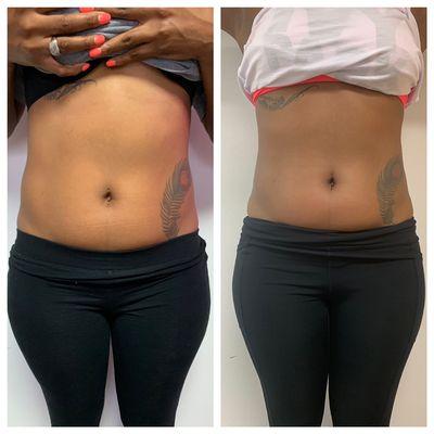 Progress photos of laser Lipo + Lipo Cavitation sessions