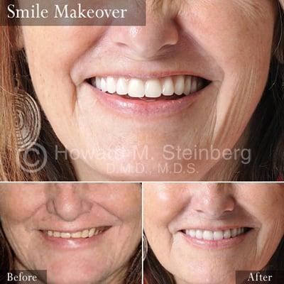 Smile Makeover in Tucson, Arizona