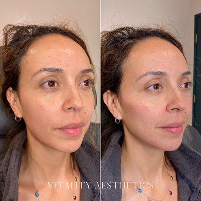 Facial balancing with filler