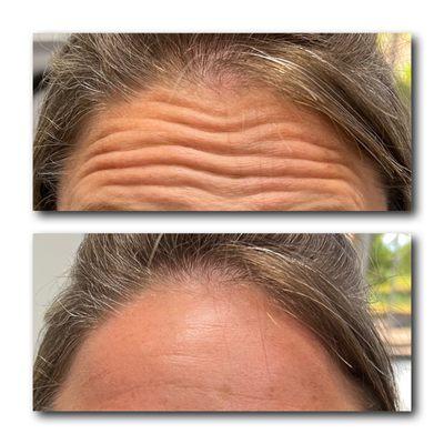 Smooth, youthful foreheads await!  Erase those lines with our expert Botox treatments. Look refreshed and rejuvenated now! #ForeheadBotox