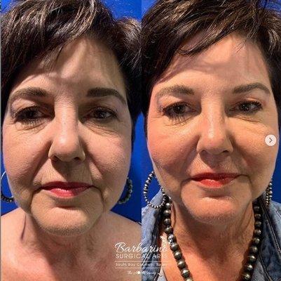 Before and two weeks after treatment with Radiesse, Belotero and Xeomin.