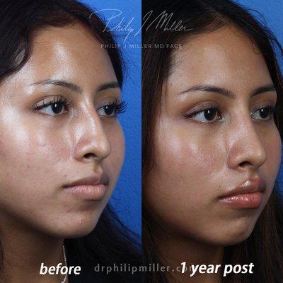 Rhinoplasty