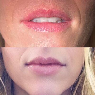 My lips before and after Dr. Patton added filler -Juvederm. I LOVE how they turned out!