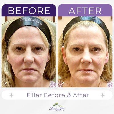 Subtle lift with fillers (2 syringes) to cheek and chin areas