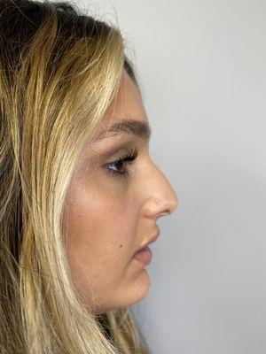 Before rhinoplasty