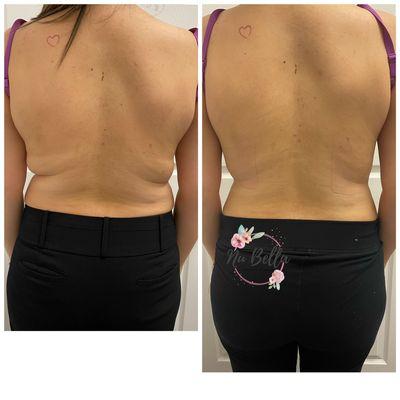 Fat blaster with Lipo Laser