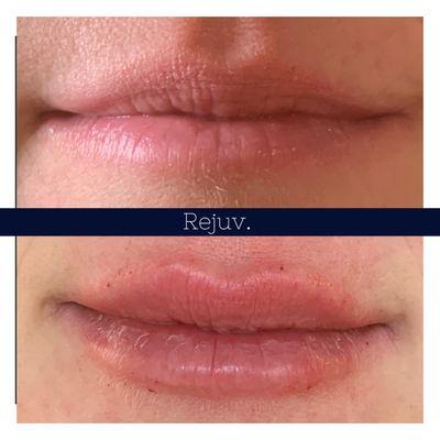 Lip filler augmentation