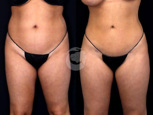 22 yo F treated with Liposuction to circumferential abdomen and Brazilian butt lift (BBL) Photos depict before and 1 month after surgery.