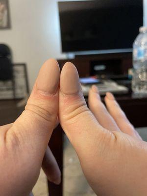 Thumbs with two completely different sized nails