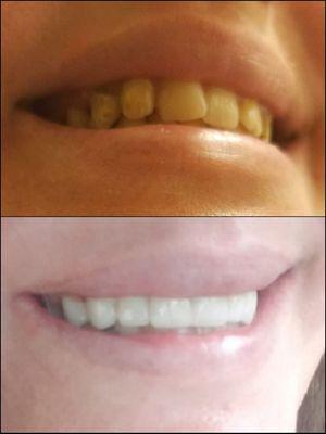 Before & after. Thank you Dr. Limbird, Tiffany & everyone at Fort Bragg Center for Laser and Cosmetic Dentistry.