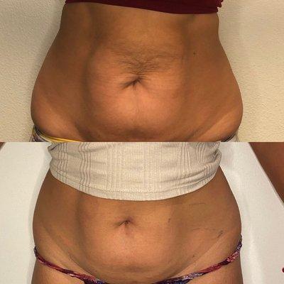 Top: before/bottom: after of skin tightening and mainly fat reduction