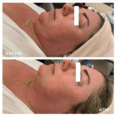 microcurrent before and after