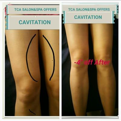 Cavitation